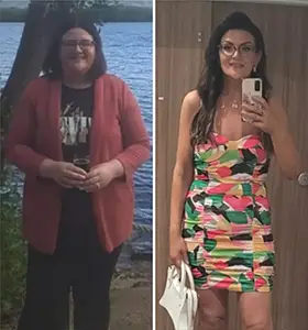 Gastric Sleeve Before After 1