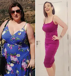 Gastric Sleeve Before After 5